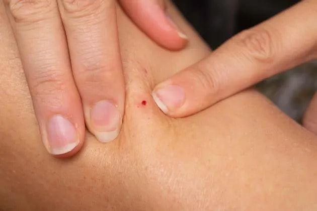 How You Should Treat A Bleeding Skin Tag – SkinPro